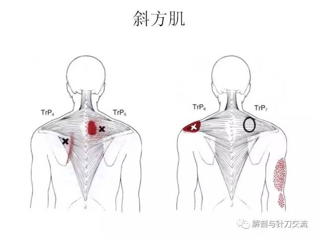 颈夹肌激痛点图片