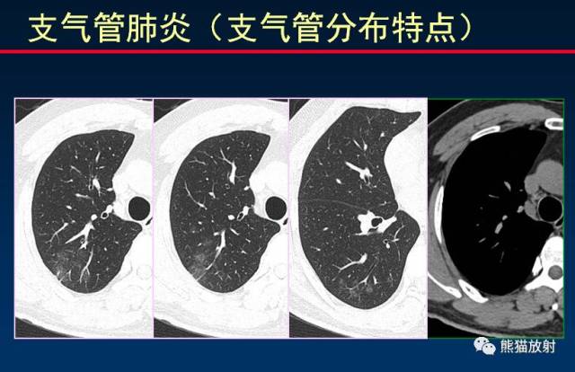 支气管周围炎可以是支气管肺炎的前驱病变,但不一定发展为支气管肺炎