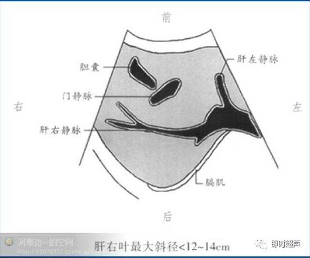 超声肝脏工字征图解图片