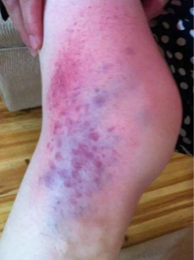 大腿上有紫色血管图片