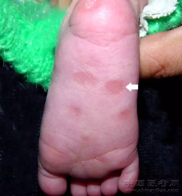 梅毒宝宝婴儿图片