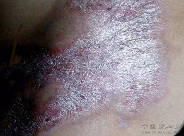 女性外阴癣的症状白斑图片