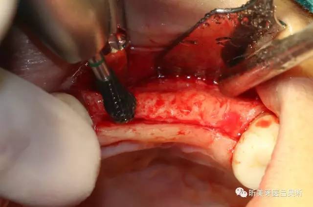 牙槽骨突出手术过程图图片
