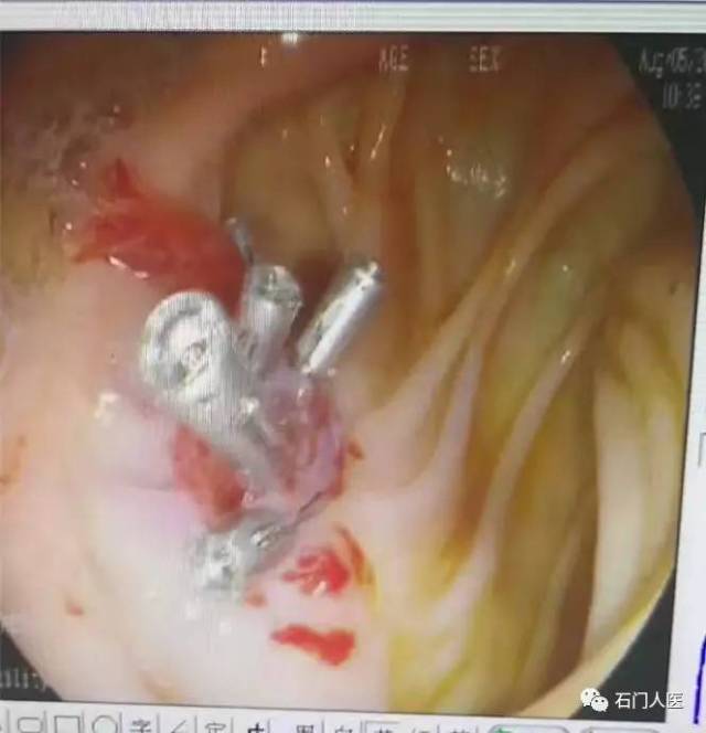 肠息肉手术钛夹图片图片