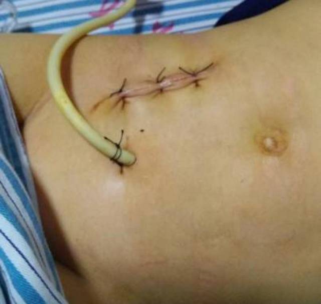腹腔镜下阑尾切除术:手术创伤极小(只需在肚皮上开2个钥匙孔大小敌