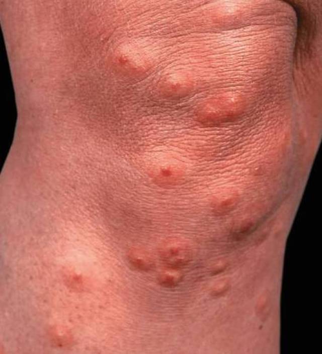 会让皮肤瘙痒,两到三天病情就达高峰 皮疹增多,瘙痒剧烈,严重的话散发
