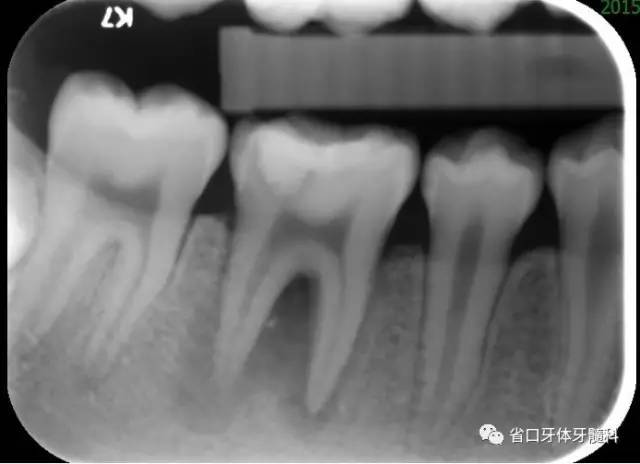 初诊x片示根尖周及根分叉大范围低密度影像 诊断:46牙髓牙周联合病 
