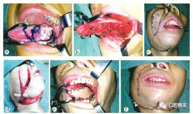 對側面動脈蒂鼻唇溝島狀瓣修復舌癌術後缺損6例臨床研究