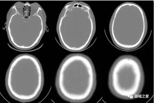 颅底ct断层解剖骨窗图片