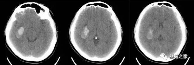 腦科icu腦出血移動ct床旁腦部掃描