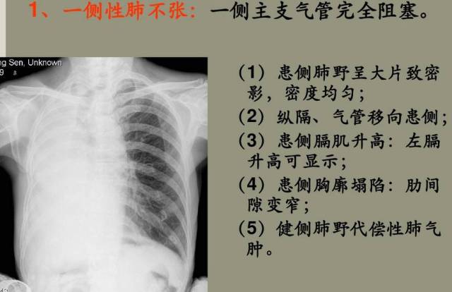 肺x线分段示意图图片