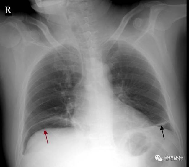 【x线诊断要点】关于肺不张,需要弄清楚以下几点