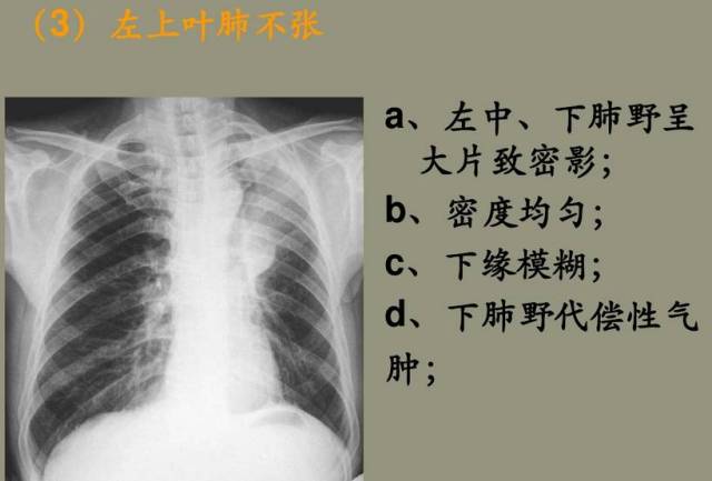 【x线诊断要点】关于肺不张,需要弄清楚以下几点