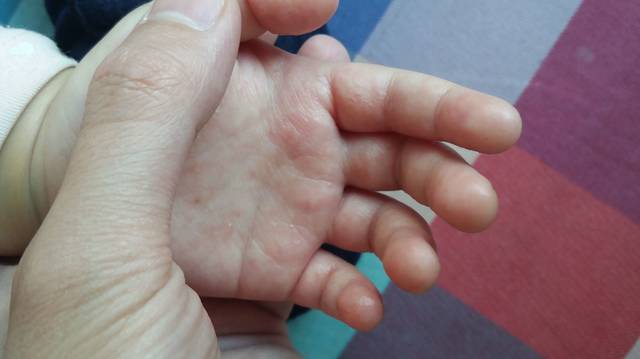 汗疱疹又称为出汗不良,为一种手掌,足跖部的水痘性疾患