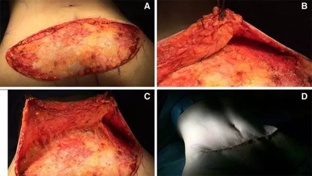 腹直肌重建乳房图片图片