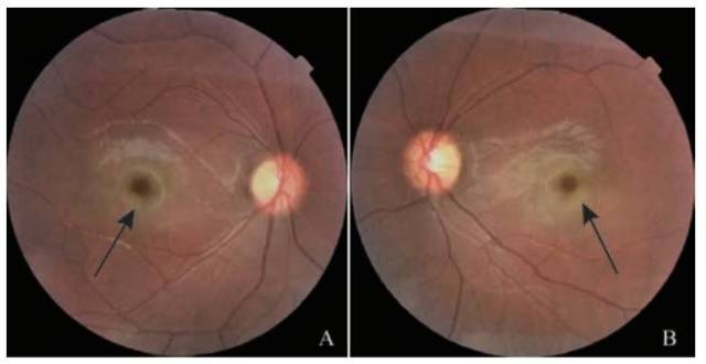 视网膜色素变性早期症状有哪些？