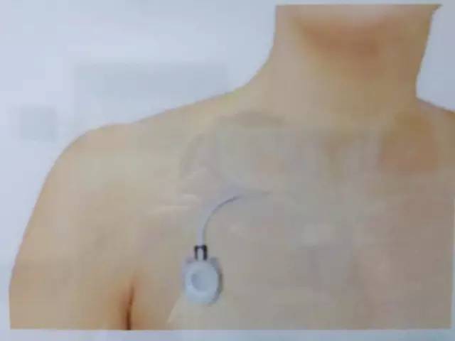 完全植入体内的静脉输液装置,主要是由供穿刺的注射座和静脉导管组成