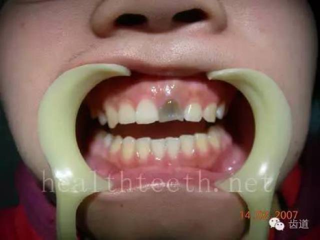 孩子的牙齿问题 乳牙未退,牙根穿出牙龈对上唇粘膜造成刺激 乳牙滞留