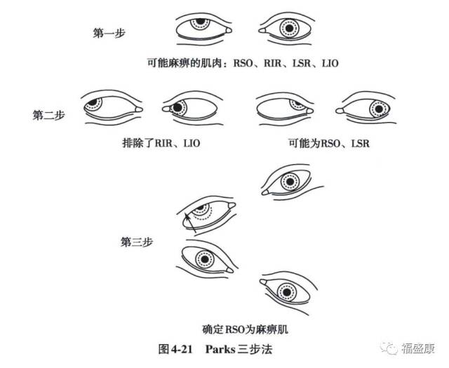 【专业】眼球转动检查《斜视弱视检查法(十七)