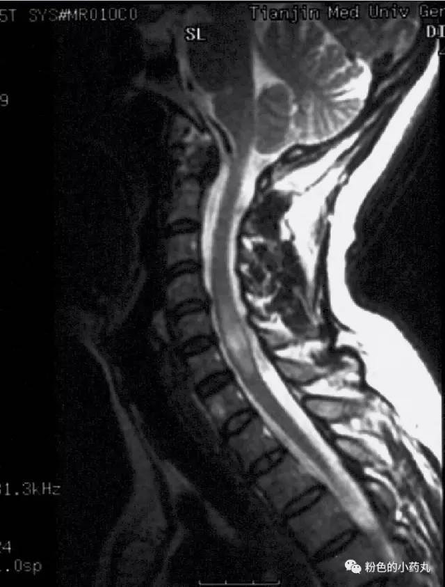 1,急性脊髓炎:多在t3