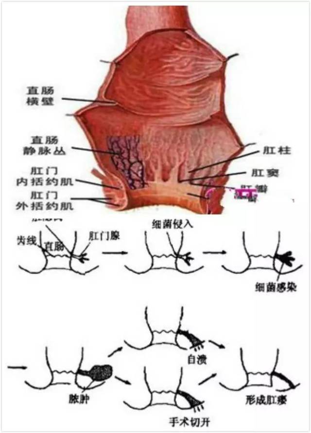 肛窦炎位置图片