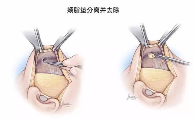 如何消除皮下脂肪_如何消除皮下脂肪瘤-www.awzn.cn