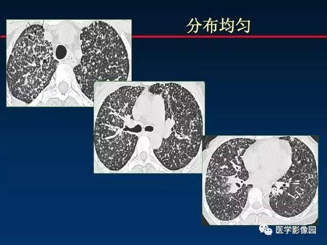 慢性血行播散型肺结核图片