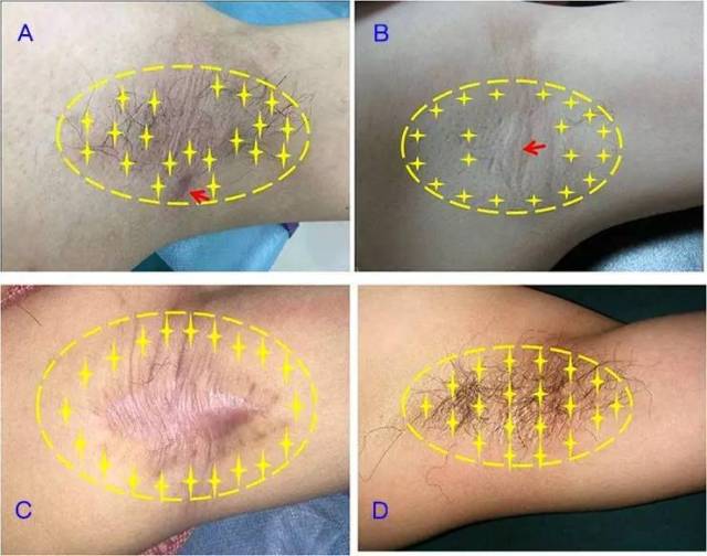 a injection for the treatment of secondary axillary bromhidrosis