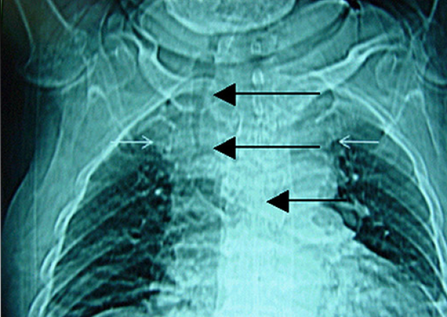 腫瘤,創傷,醫源性因素和外部病變如胸內甲狀腺腫(圖10)壓迫所導致的