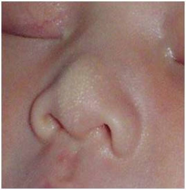 新生儿正常嘴巴图图片