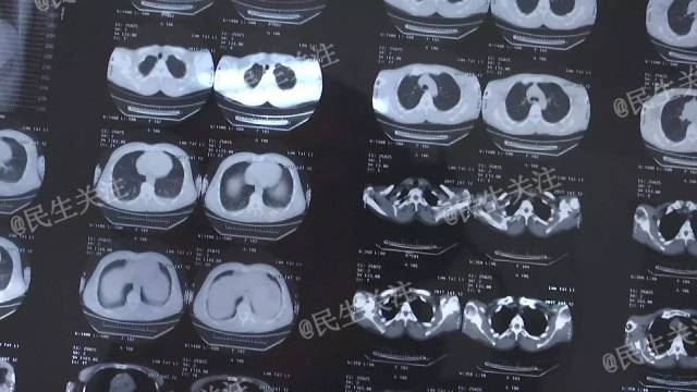 他是高墜傷三米多高摔下來,ct上有一個肋骨骨折還有少量的胸腔積液