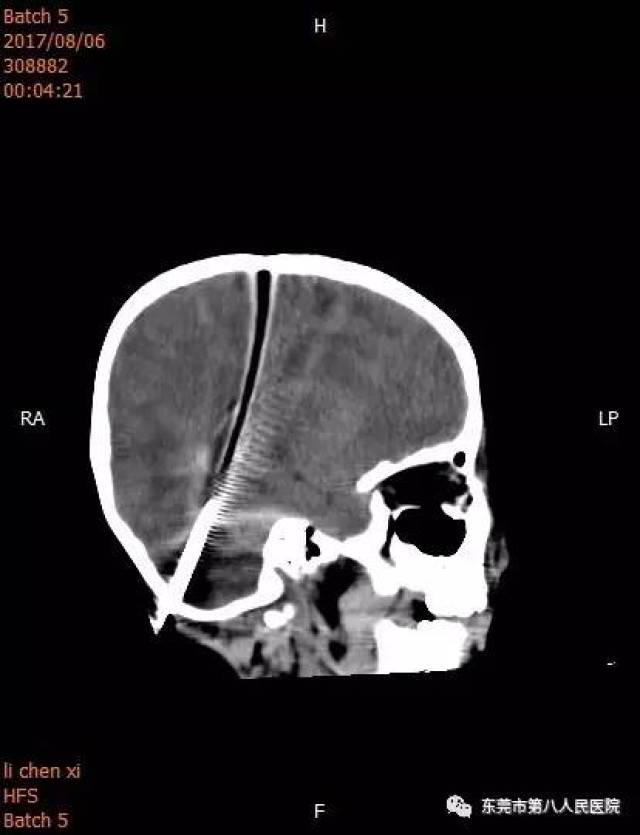 术前头颅ct照片