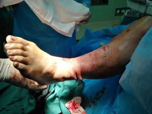 下肢遭遇电缆绞断 总医院多学科联合成功再植让年轻患者重获新生