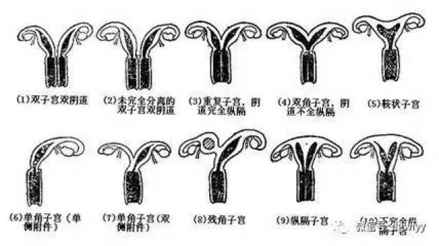各种子宫畸形,如单角子宫,双角子宫,舟状子宫,双子宫,子宫横隔或纵隔