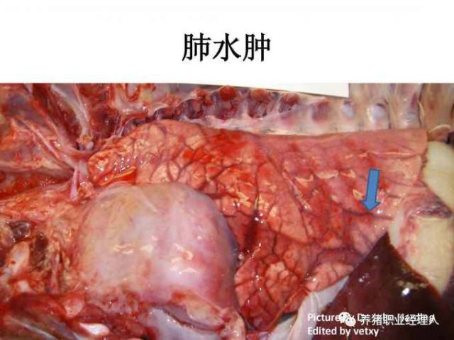 下面是典型的肺水肿图片,小叶间间质增宽,有渗出液