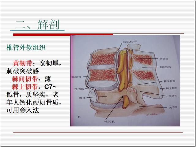 硬膜外麻醉侧入法图谱图片