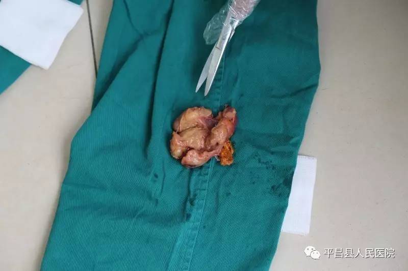 泌尿外科 ‖ 果断出击:后腹腔镜下5厘米肾上腺肿瘤连根挖出