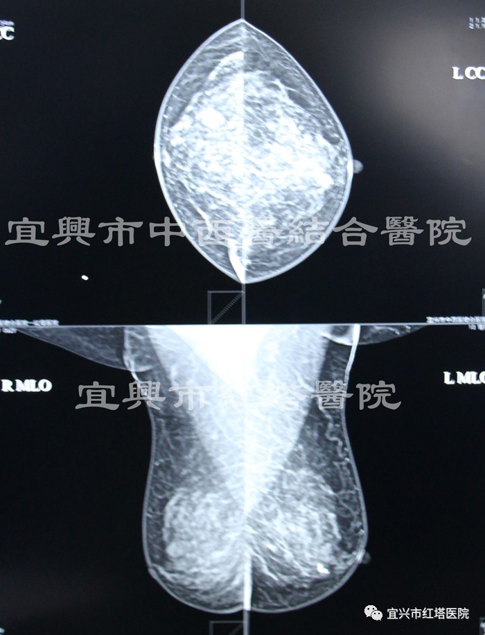 能比較全面而正確地反應出整個乳房的大體解剖結構;02利用x線檢查可以