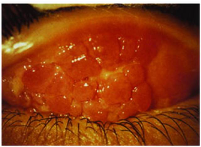 结膜伪膜图片图片