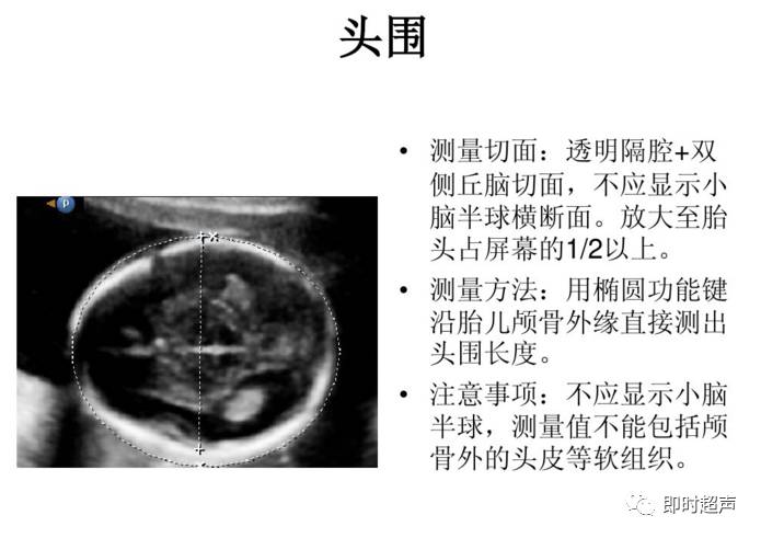 产科超声标准切面25张图