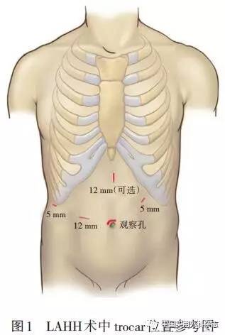 31 体位与戳孔位置 lahh病人一般选仰卧位或仰卧分腿位