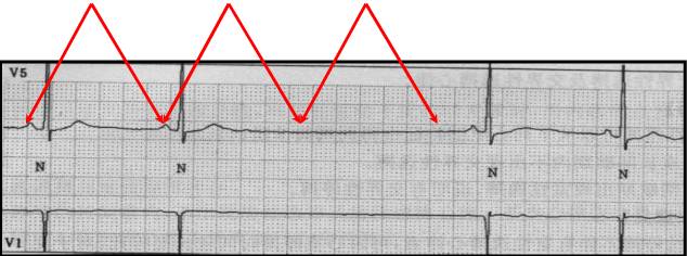 窦房结心电图特征图片