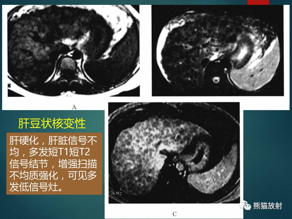 肝糖原累積症瀰漫性肝實質密度增高病變的鑑別診斷