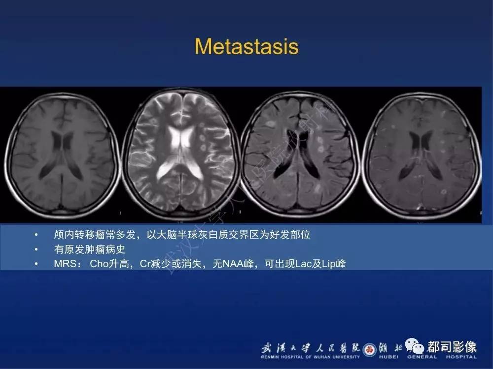 顱內梅毒樹膠腫影像診斷