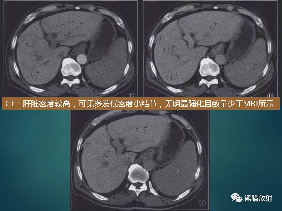 肝糖原累積症瀰漫性肝實質密度增高病變的鑑別診斷