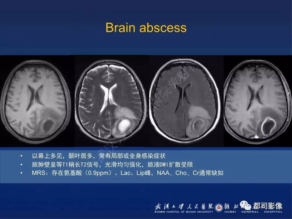 顱內梅毒樹膠腫影像診斷