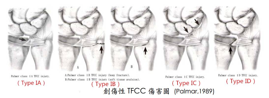 腕關節2tfcc損傷解析及康復