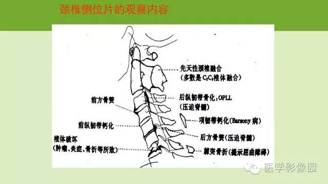 半脫位的臨床診斷;3.脊椎骨關節解剖特點;4.脊椎臨床實用生物力學;5.