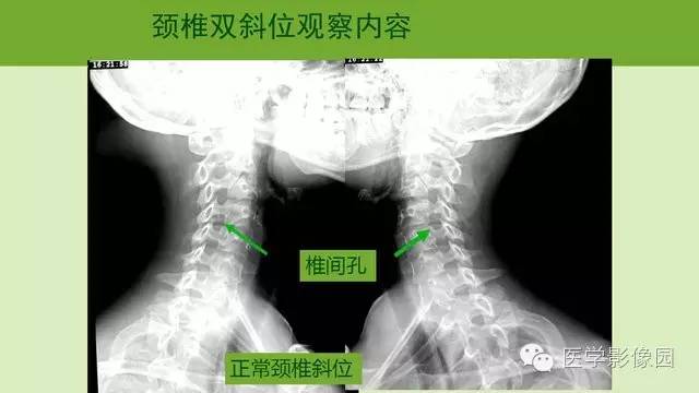 超全面超基礎超級頸椎影像閱片方法