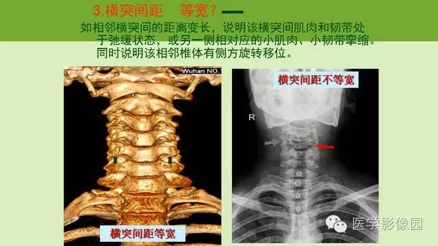 正常颈椎间盘ct图解图片